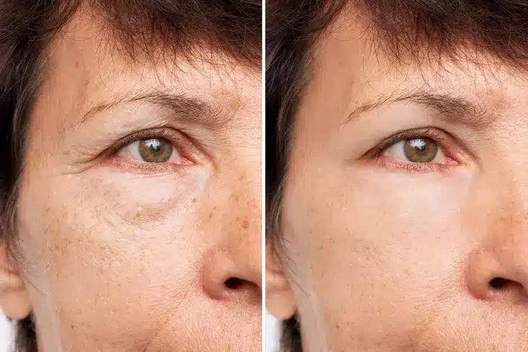 blepharoplasty-surgery-2