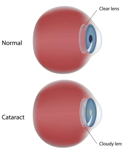 Corneal-Transplant-895x1024.jpg