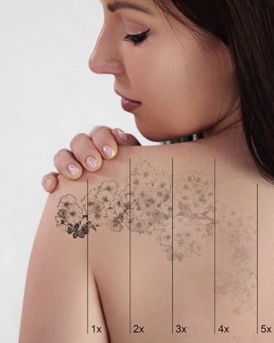 Laser Tattoo Removal