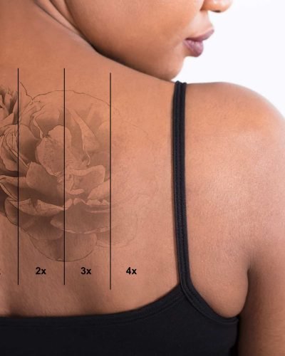Laser Tattoo Removal